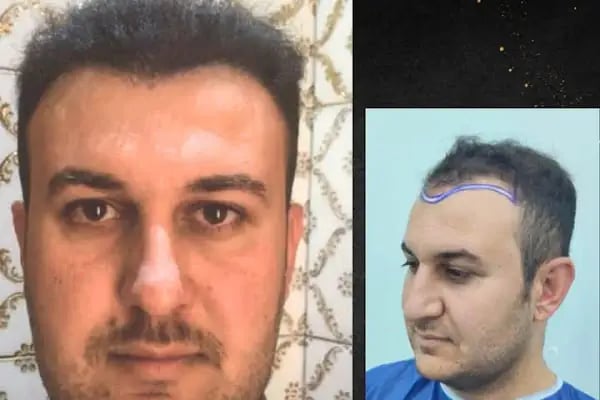 yordam hair saç ekim - Resim 4