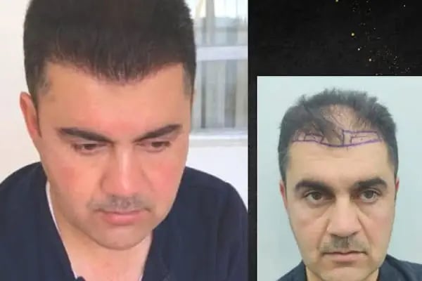 yordam hair saç ekim - Resim 5