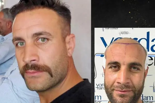 yordam hair saç ekim - Resim 1
