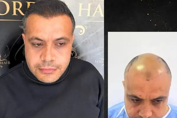 yordam hair saç ekim - Resim 7