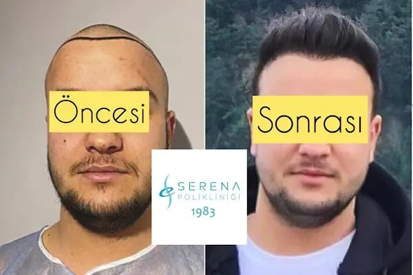 İzmir Saç Ekimi | İzmir Hair Transplantation | Serena Polikliniği | İzmir Kaş Ekimi - Resim 12
