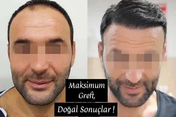 İzmir Saç Ekimi | İzmir Hair Transplantation | Serena Polikliniği | İzmir Kaş Ekimi - Resim 3