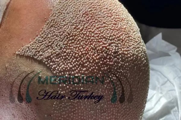 Meridian Hair Turkey - Resim 20
