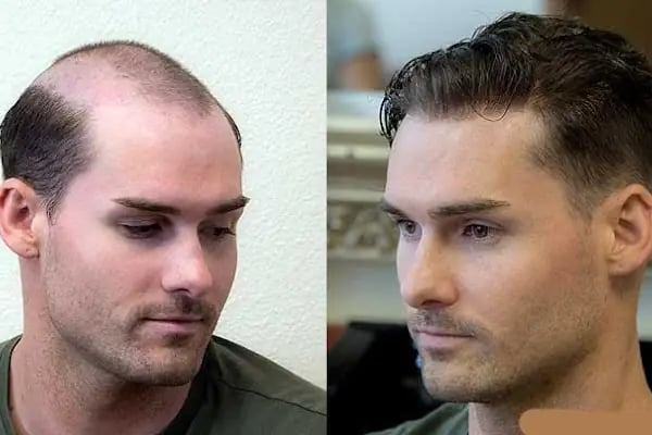 PROTEZ SAÇ HAIR CENTER diyarbakır - Resim 3