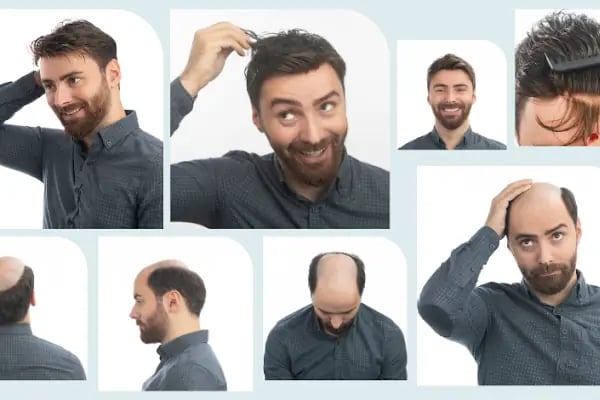 PROTEZ SAÇ HAIR CENTER diyarbakır - Resim 5