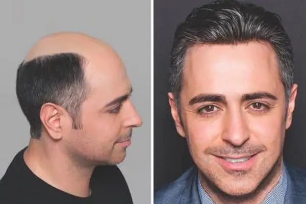 PROTEZ SAÇ HAIR CENTER diyarbakır - Resim 7