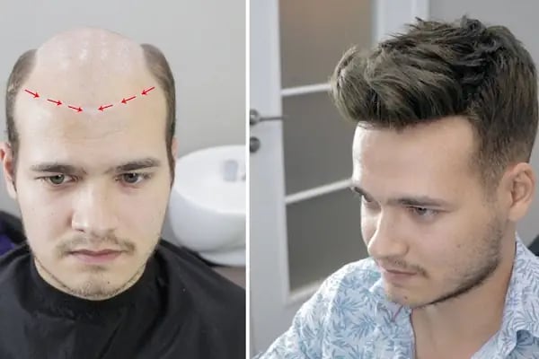 PROTEZ SAÇ HAIR CENTER diyarbakır - Resim 2