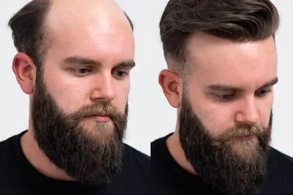 PROTEZ SAÇ HAIR CENTER diyarbakır - Resim 4