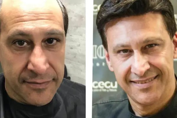 PROTEZ SAÇ HAIR CENTER diyarbakır - Resim 6