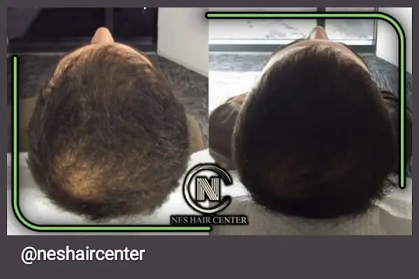 Nes Hair Center - Resim 19