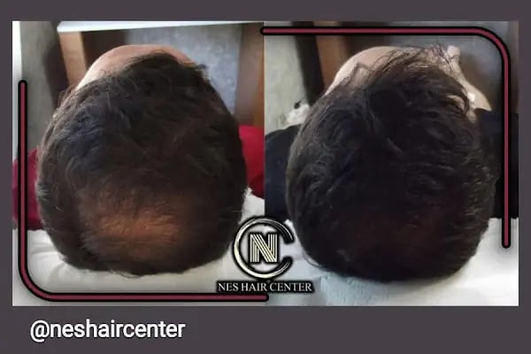 Nes Hair Center - Resim 9