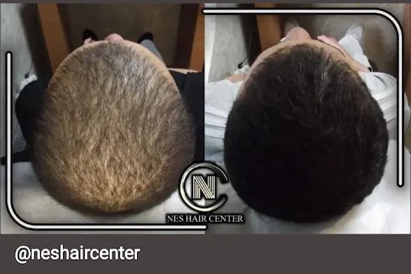 Nes Hair Center - Resim 15