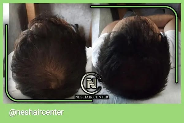 Nes Hair Center - Resim 5