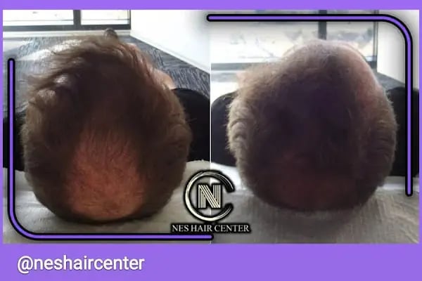 Nes Hair Center - Resim 16