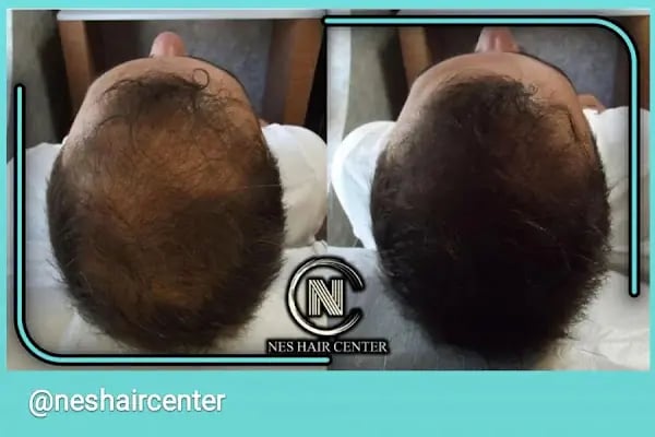 Nes Hair Center - Resim 7