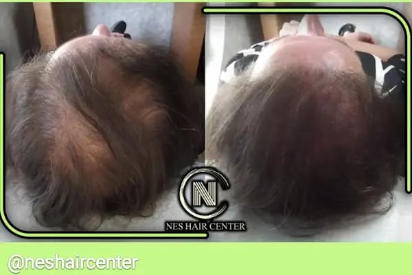 Nes Hair Center - Resim 2