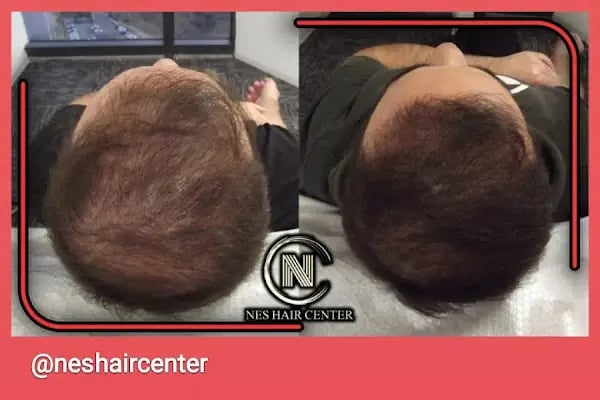Nes Hair Center - Resim 12