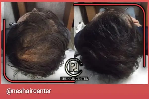Nes Hair Center - Resim 17