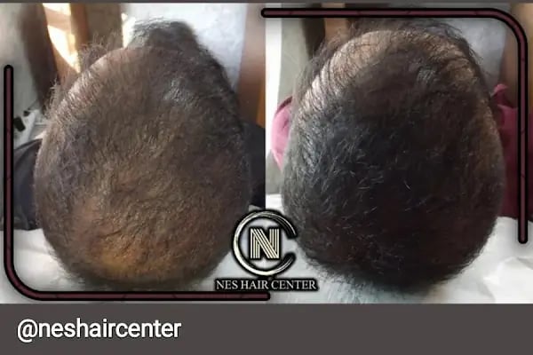 Nes Hair Center - Resim 11
