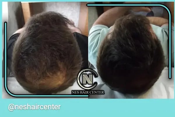 Nes Hair Center - Resim 6