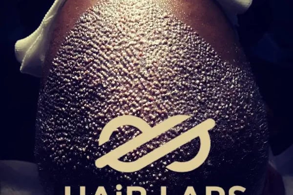 Hairlaps clinic - Resim 19
