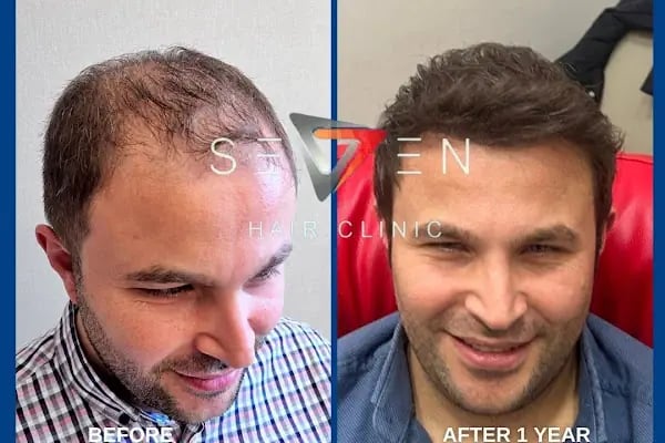 Seven Hair Clinic - Resim 19