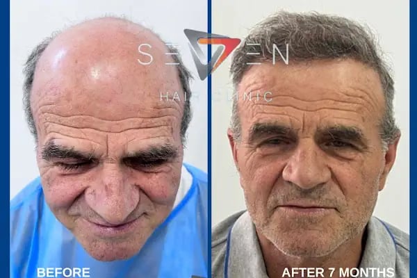 Seven Hair Clinic - Resim 15