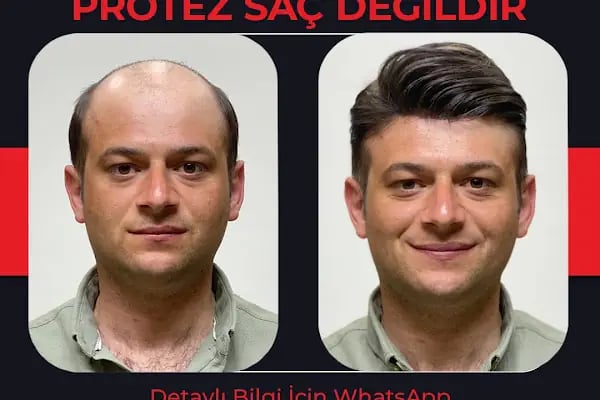 Bulut Protez Saç Merkezi - Resim 19