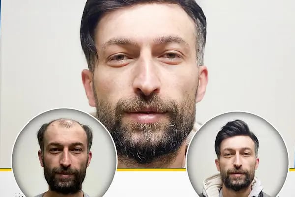Bulut Protez Saç Merkezi - Resim 15