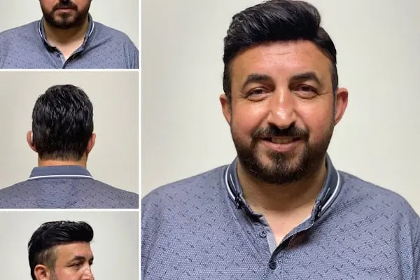 Bulut Protez Saç Merkezi - Resim 13