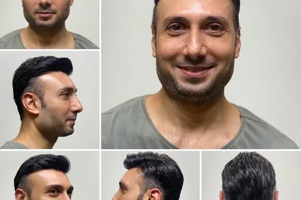 Bulut Protez Saç Merkezi - Resim 12