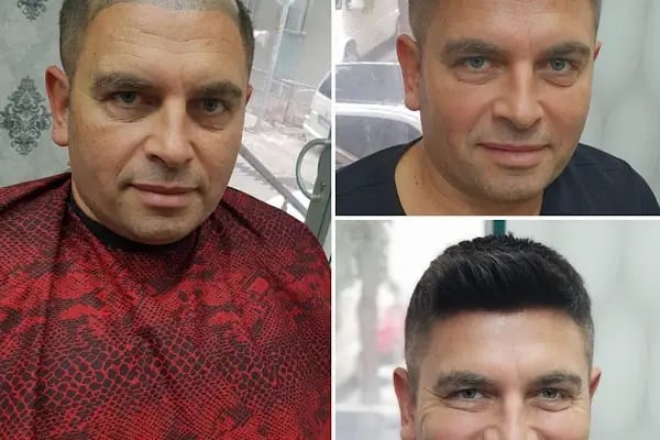 Bulut Protez Saç Merkezi - Resim 20