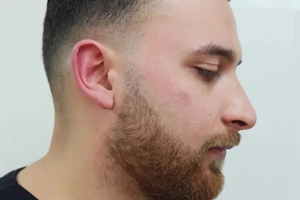 Bulut Protez Saç Merkezi - Resim 6