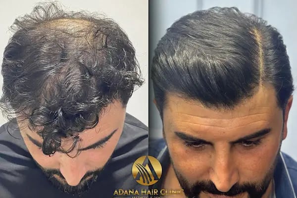 Adana Hair Clinic - Hair Transplant in Adana - Resim 11