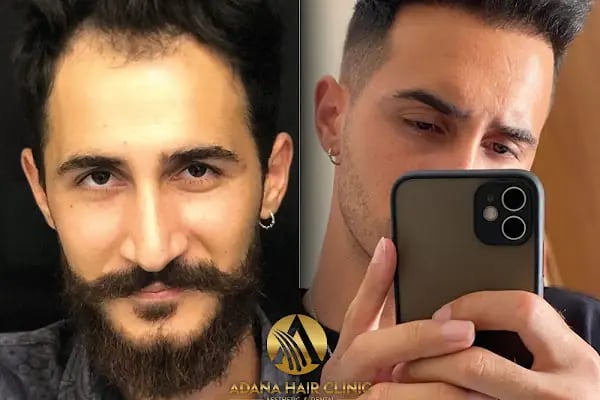 Adana Hair Clinic - Hair Transplant in Adana - Resim 8