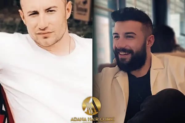 Adana Hair Clinic - Hair Transplant in Adana - Resim 10
