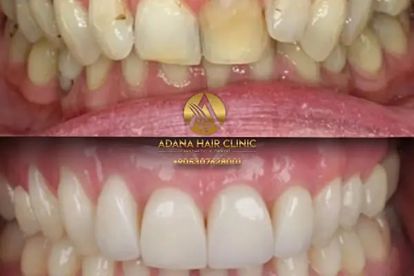 Adana Hair Clinic - Hair Transplant in Adana - Resim 3