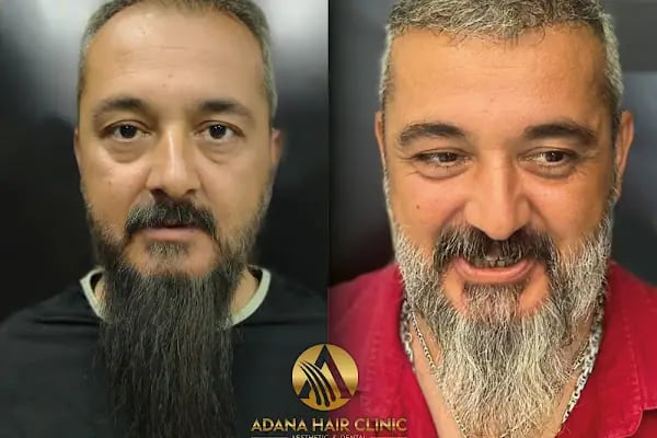 Adana Hair Clinic - Hair Transplant in Adana - Resim 17