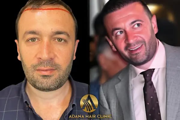 Adana Hair Clinic - Hair Transplant in Adana - Resim 16