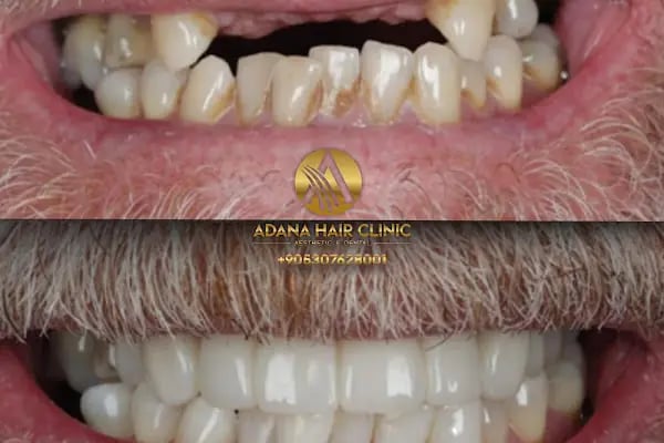 Adana Hair Clinic - Hair Transplant in Adana - Resim 2