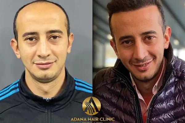 Adana Hair Clinic - Hair Transplant in Adana - Resim 13