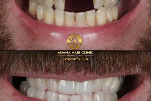 Adana Hair Clinic - Hair Transplant in Adana - Resim 6