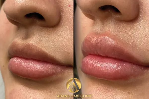 Adana Hair Clinic - Hair Transplant in Adana - Resim 4
