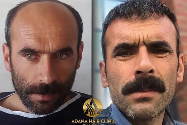 Adana Hair Clinic - Hair Transplant in Adana - Resim 18