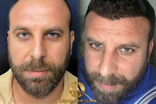 Adana Hair Clinic - Hair Transplant in Adana - Resim 15