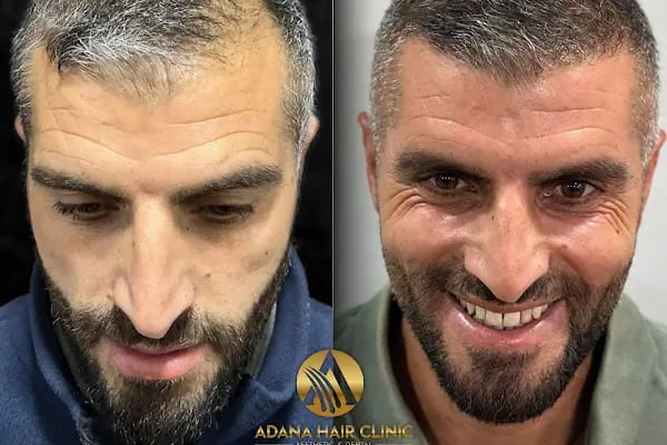 Adana Hair Clinic - Hair Transplant in Adana - Resim 12