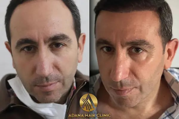 Adana Hair Clinic - Hair Transplant in Adana - Resim 19