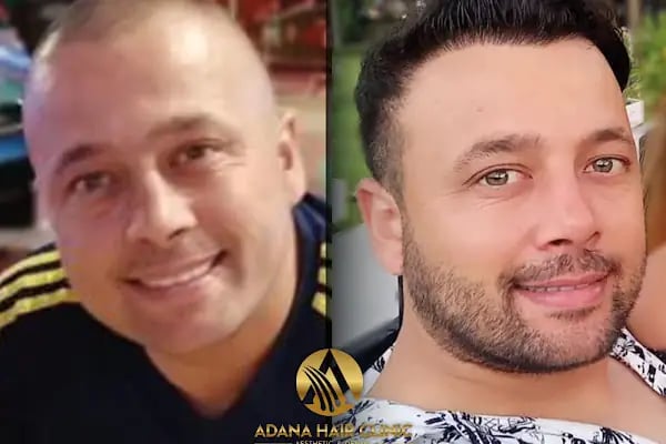 Adana Hair Clinic - Hair Transplant in Adana - Resim 9
