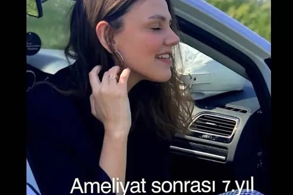 Bursa Burun Estetiği Op. Dr. Ümit Çakır - Resim 15