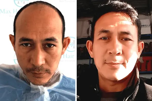 Max Hair Center - Resim 17